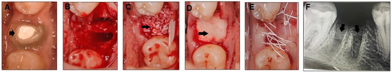 Effect of two deproteinized bone graft materials for socket preservation: a clinical and histological study.