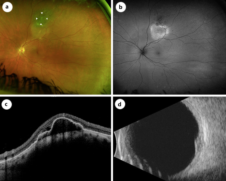 Case Series: Retinal Pigment Epithelial Detachments Over Choroidal Nevi - What Is the Clinical Significance?