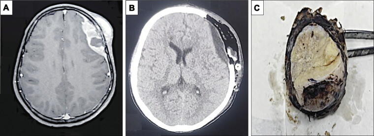 Ewing's Sarcoma of the Frontal Bone with Intracranial Extension.