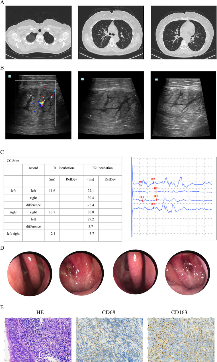 Dupilumab-induced Eosinophilic Granulomatosis with Polyangiitis Complicated by Peripheral Neuropathic Pain: a Case Report and Literature Review.