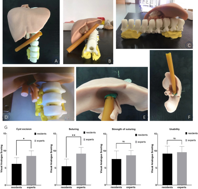 The novel technique for surgical simulation training of patient-specific silicone models of pediatric congenital choledochal cysts.