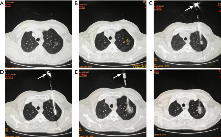 Synchronous percutaneous microwave ablation combined with percutaneous biopsy for highly suspected malignant pulmonary nodules: a retrospective study.