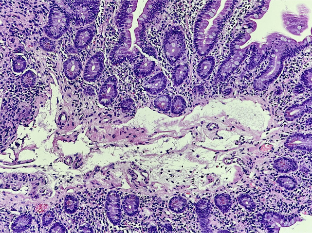 Elusive Edematous Primary Intestinal Lymphangiectasia in an Adult Patient Presenting With New Onset of Protein-Losing Enteropathy.