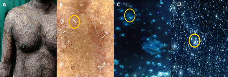 Are Blue Straggler Stars a Hidden Clue? Intriguing Discovery in Pityriasis Rubra Pilaris Under UV-Induced Fluorescence Dermoscopy.