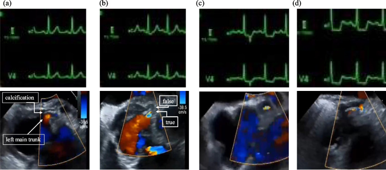 Progressive coronary stenosis detected by intraoperative TEE after acute type-A aortic dissection repair: a case report.