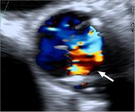 Early Structural Valve Deterioration and Cusp Tear Leading to Acute Heart Failure in a Second-Generation Trifecta Glide Technology Heart Valve.