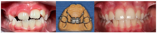 Results of orthodontic procedure in a patient with classic infantile Pompe disease.