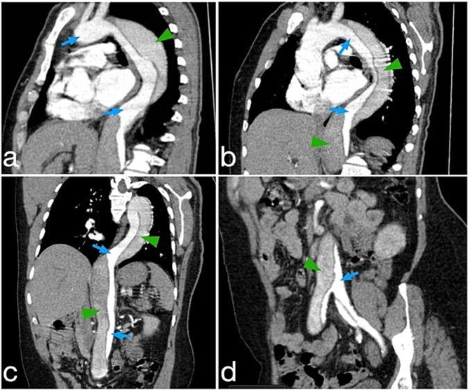 Aortic dissection presenting with Hemoptysis: a diagnostic challenge.