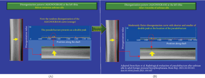Improvements in Bone Disorganization and Pseudo-Fracture Healing in Hypophosphatasia Following Asfotase Alfa Therapy May Be Detectable by the ALIGNOGRAM Before Changes in Bone Radiography or Scintigraphy.