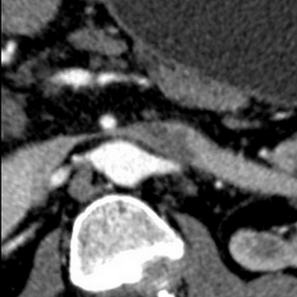 Left renal vein thrombosis with nutcracker syndrome.