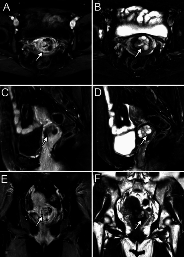Gastric-type endocervical adenocarcinoma in situ as the presenting feature in a mosaic STK11 pathogenic variant carrier with a Peutz-Jeghers syndrome child.