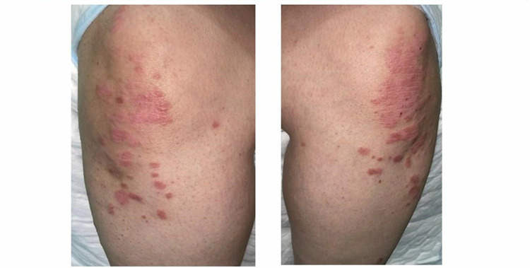 Hepatotoxicity Induced by Adalimumab in Chronic Plaque Psoriasis Patient: A Case Report.