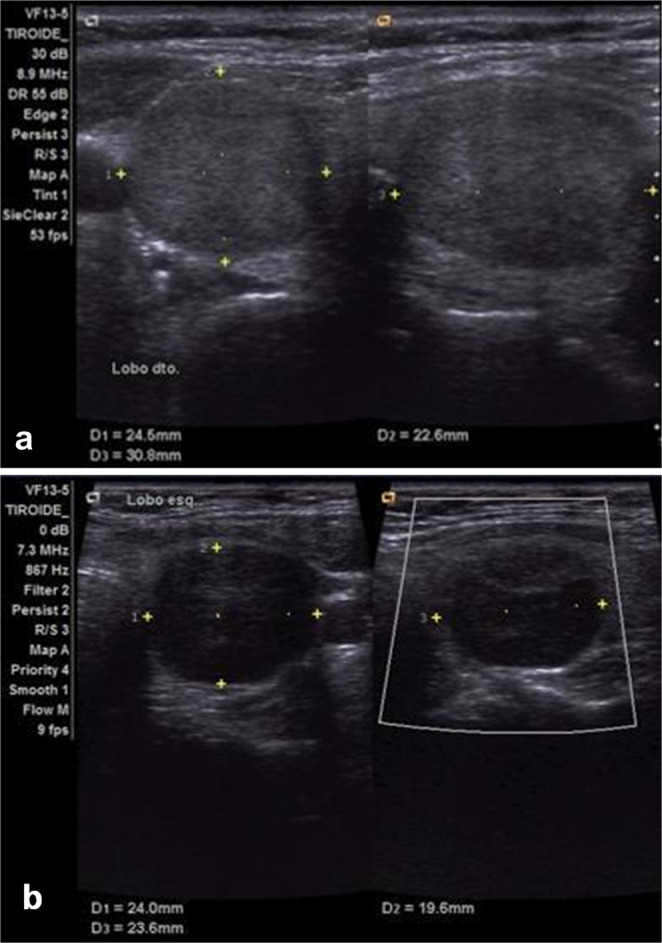 Preoperative assessment of NIFTP clinicopathological characteristics and its impact on avoiding overtreatment.