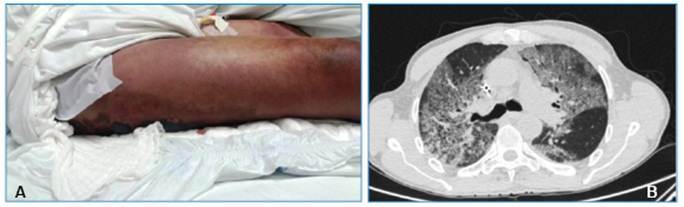 Secondary infection with Aeromonas hydrophila and death of two patients with probable Bothrops envenomation.
