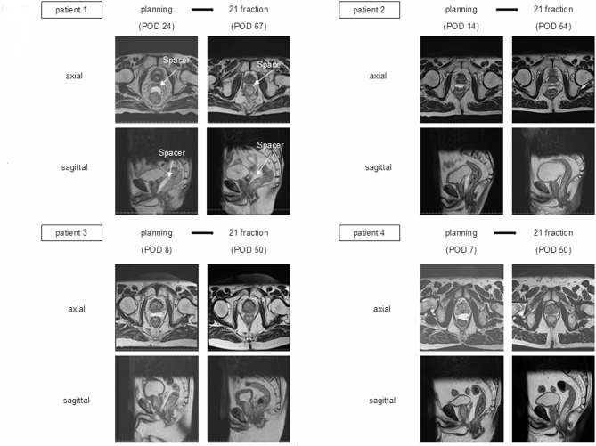 Evaluation of the changes in hydrogel spacer volume in patients treated with proton therapy for prostate cancer.