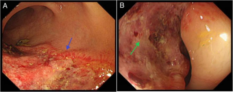 A "mass-forming" variant of ischemic colitis following COVID infection: a case report and review.