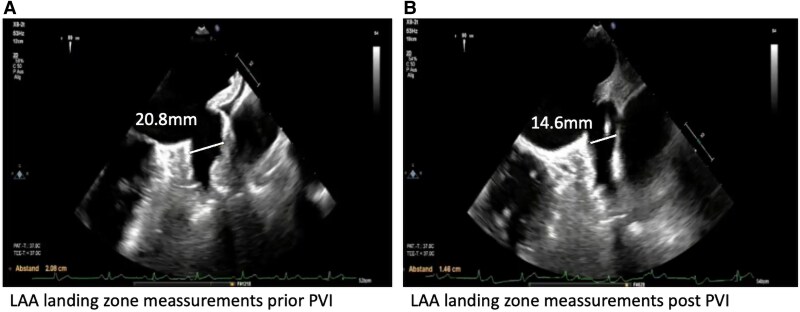 Streamlined concomitant pulse field ablation-based pulmonary vein isolation and left atrial appendage occlusion via a single venous access approach: a case report.