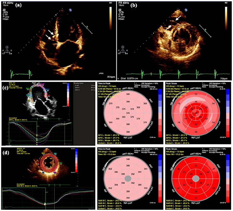 Benefits of Simultaneous Pacing Left Anterior/Posterior Fascicular Areas Combined with Atrioventricular Node Ablation in a Persistent Atrial Fibrillation Patient with Heart Failure: A Case Report.