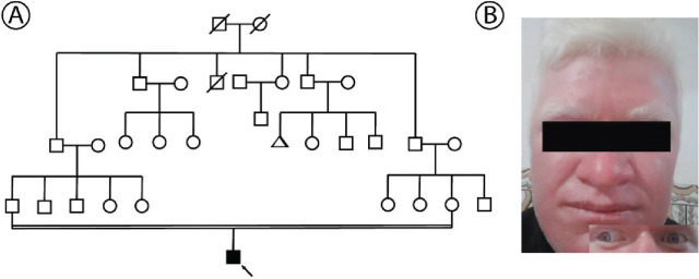 Oculocutaneous albinism in a patient with an <i>OCA2</i> variant: molecular and clinical insights.