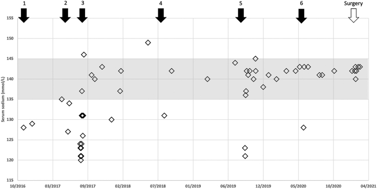 SIADH as an uncommon presentation of olfactory neuroblastoma: a case-based overview.