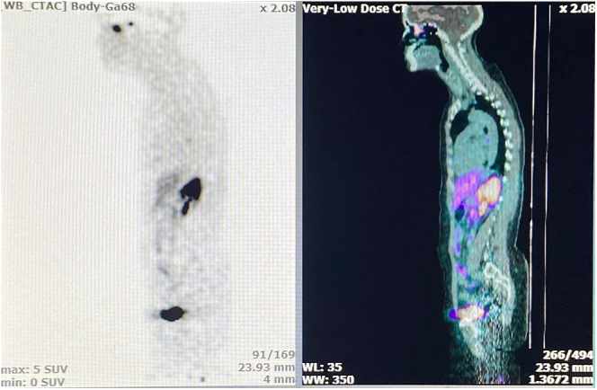 SIADH as an uncommon presentation of olfactory neuroblastoma: a case-based overview.