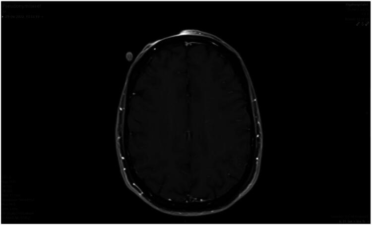 Uncommon presentation of dermatofibrosarcoma protuberans: extensive growth in a rare location with subclinical cutaneous manifestation-a case report.