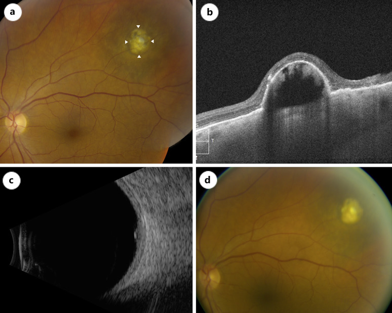 Case Series: Retinal Pigment Epithelial Detachments Over Choroidal Nevi - What Is the Clinical Significance?