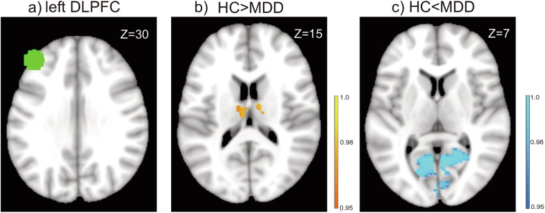 Exploring the capabilities of repetitive transcranial magnetic stimulation in major depressive disorder: Dynamic causal modeling of the neural network.