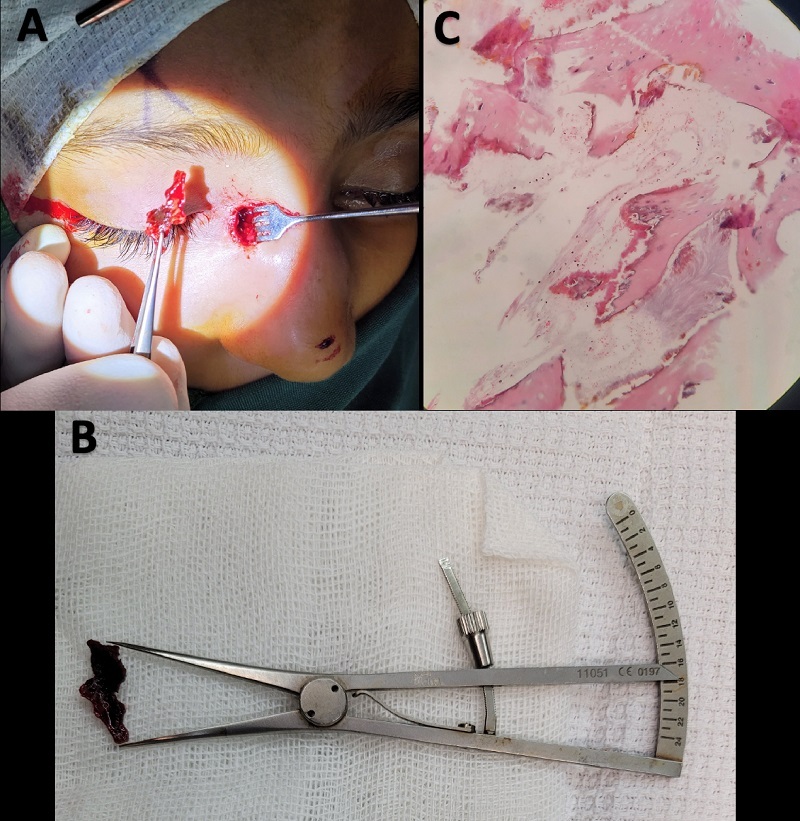 Heterotopic Ossification Originating from the Lacrimal Sac of a Child: A Case Report.