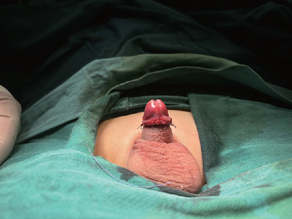 Observation on the therapeutic effect of a modified Devine procedure with subcutaneous sliding fixation method for concealed penis.