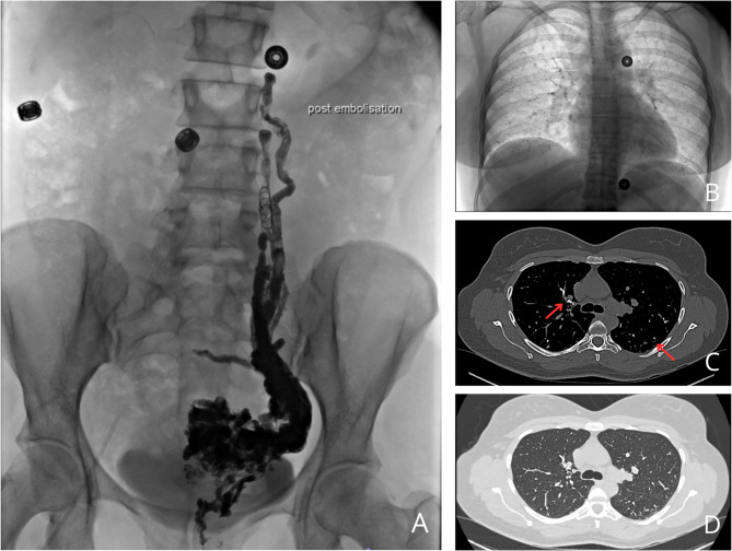 Pulmonary glue embolism after radiological embolization of pelvic varices: a case report.