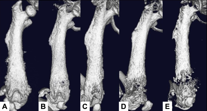 Effect of Zoledronic Acid Administration Timing on Metastatic Bone Tumors.