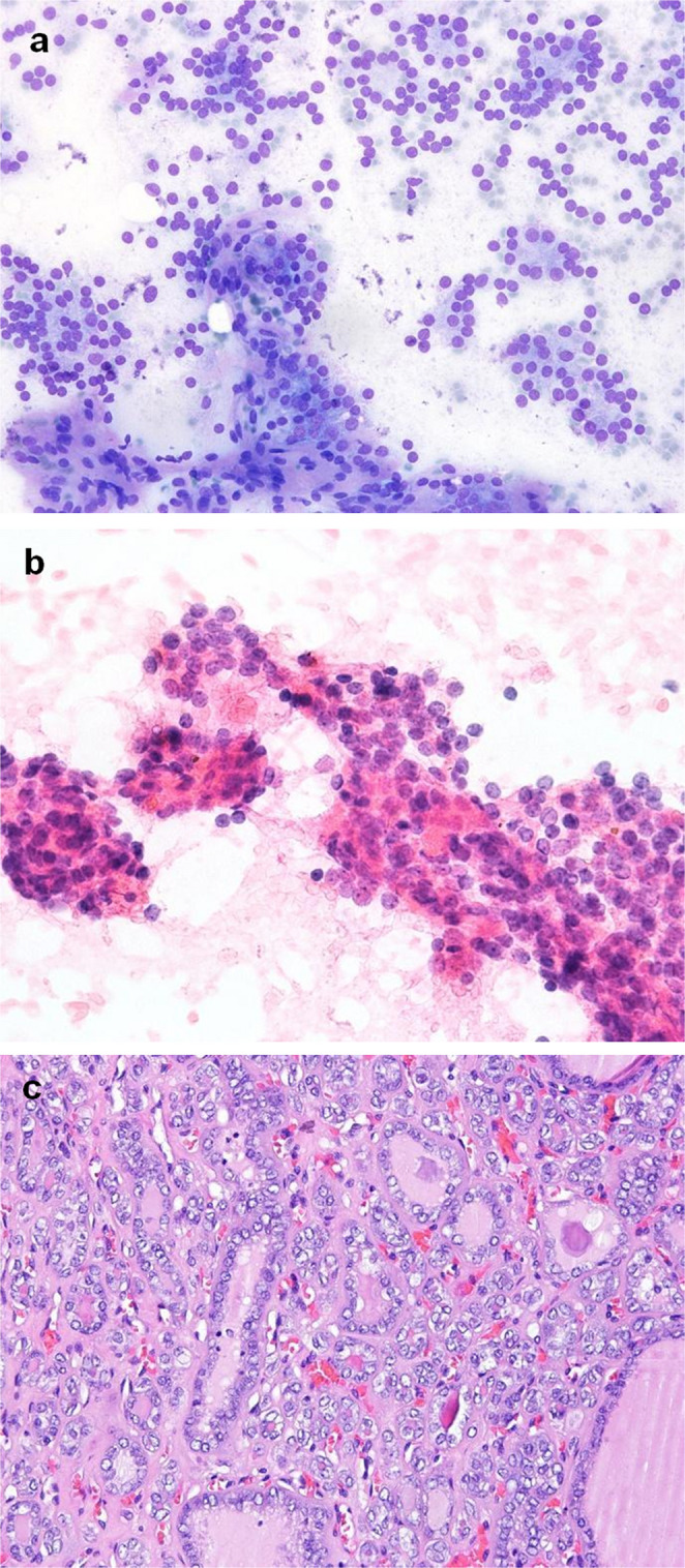 Preoperative assessment of NIFTP clinicopathological characteristics and its impact on avoiding overtreatment.