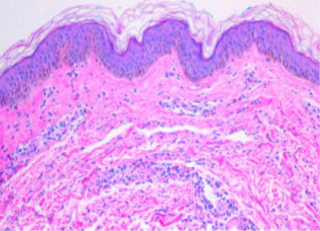 Leukocytoclastic Vasculitis in JAK2-Positive Essential Thrombocythemia: A Case of Cytokine-Driven Urticarial Rash Responsive to Ruxolitinib.