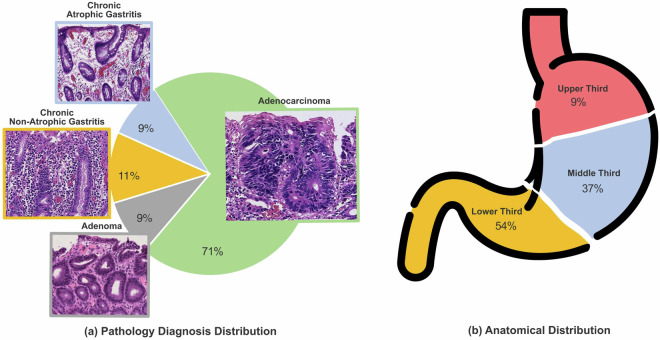 A fully annotated pathology slide dataset for early gastric cancer and precancerous lesions.