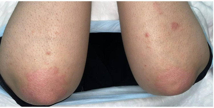 Hepatotoxicity Induced by Adalimumab in Chronic Plaque Psoriasis Patient: A Case Report.