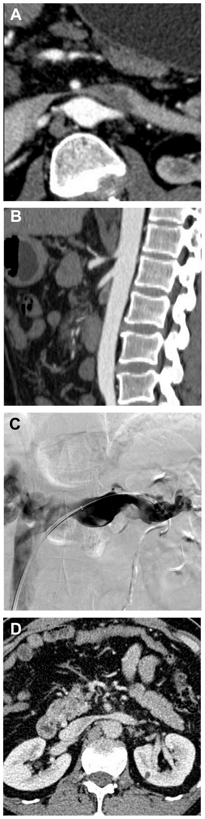 Left renal vein thrombosis with nutcracker syndrome.