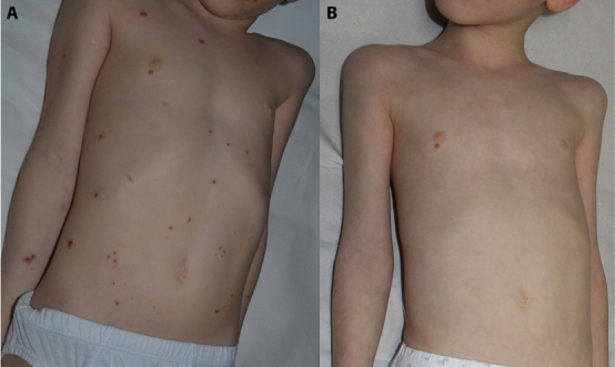The Effect of Dupilumab on Growth Parameters in Pediatric Atopic Dermatitis Patients.