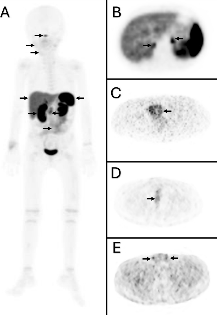 Physiological bio-distribution of 68Ga-DOTA-TATE in pediatric patients
