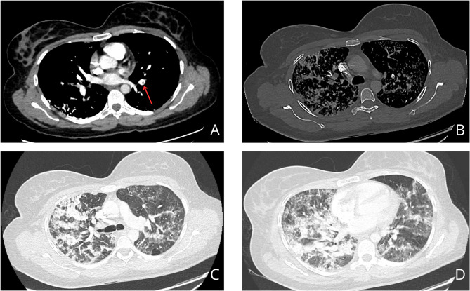 Pulmonary glue embolism after radiological embolization of pelvic varices: a case report.