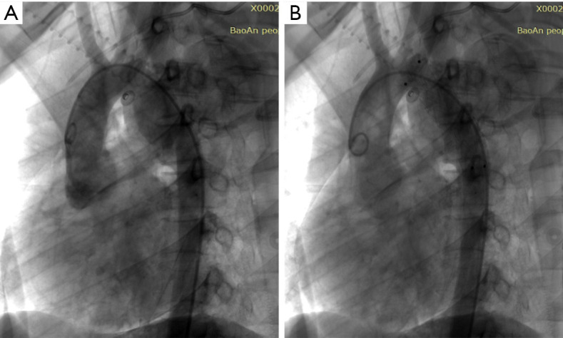 Endovascular treatment of a blunt thoracic aortic injury in adolescents: a case report.