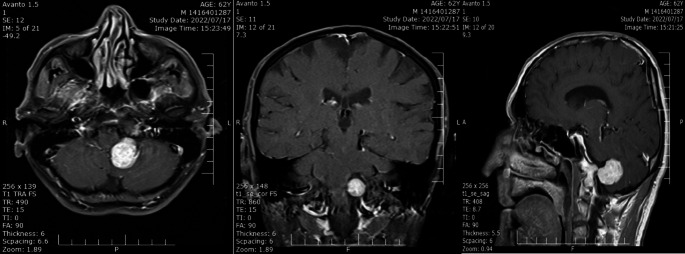 An overview of definition and approaches to jugular fossa tumors.