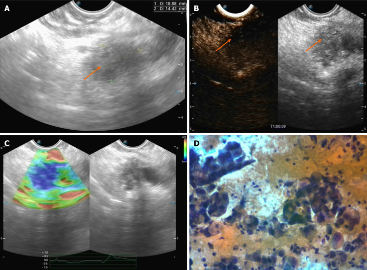Diagnostic value of endoscopic ultrasound in staging of pancreatic cancer.