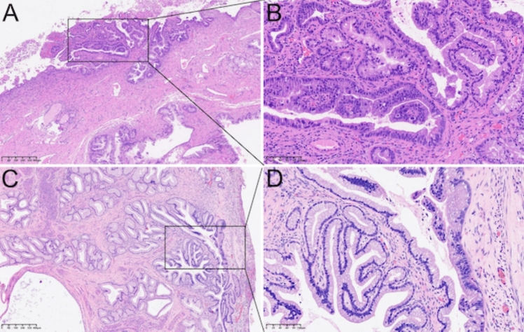 Gastric-type endocervical adenocarcinoma in situ as the presenting feature in a mosaic STK11 pathogenic variant carrier with a Peutz-Jeghers syndrome child.