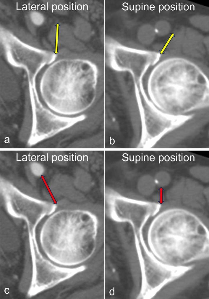 Changes in the anatomical positions of the femoral nerve and artery in the lateral and supine positions: a multicenter retrospective study.