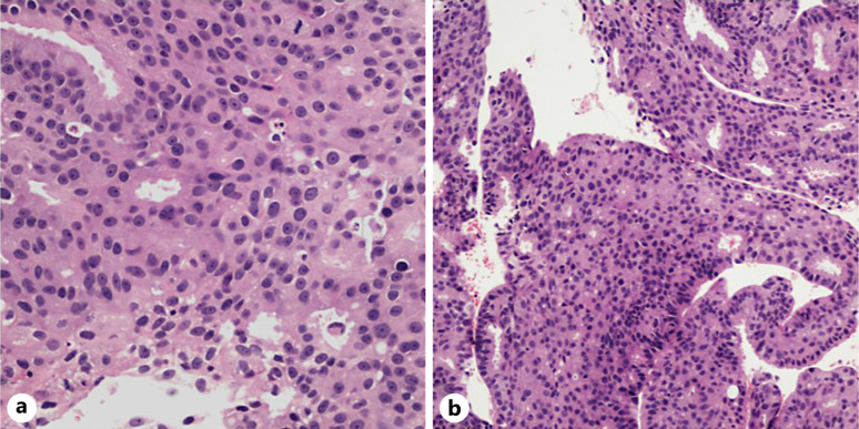 Rare Case of Metastatic Breast Cancer to the Sphenoid Sinus: Diagnosis and Treatment.