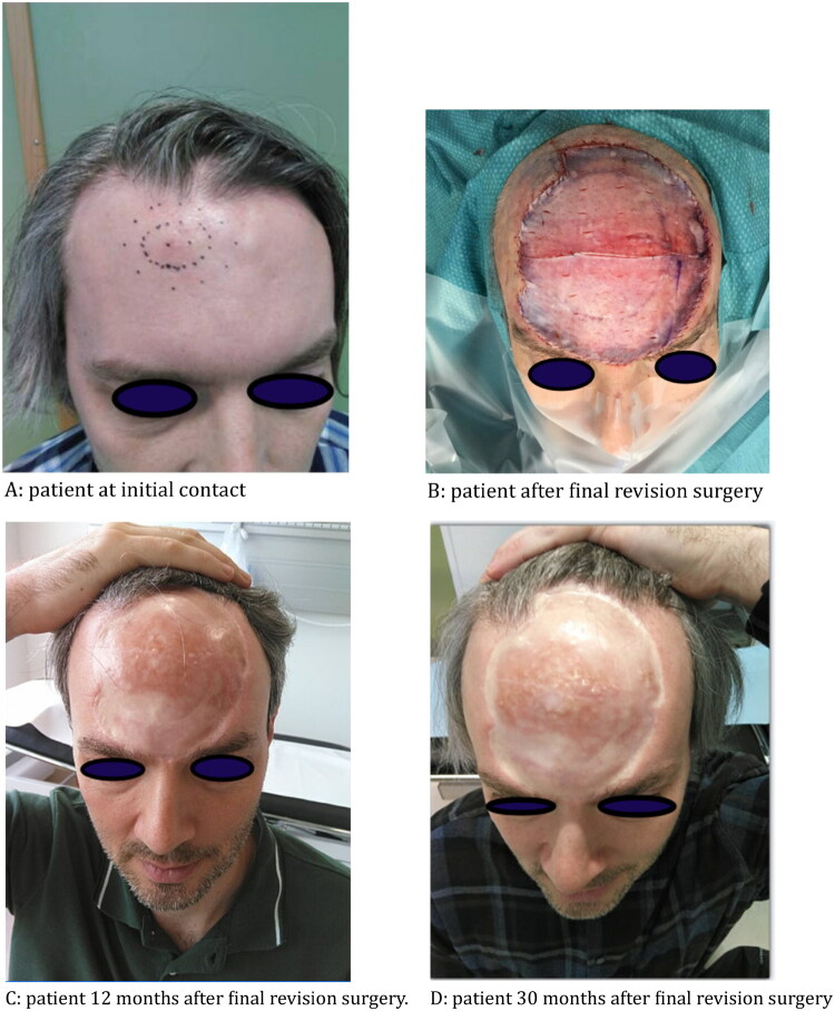 Uncommon presentation of dermatofibrosarcoma protuberans: extensive growth in a rare location with subclinical cutaneous manifestation-a case report.