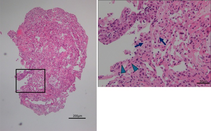 Regorafenib Induced Interstitial Pneumonia in a Patient With Refractory Rectal Cancer.