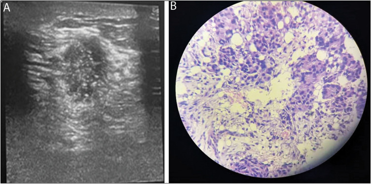 Assessing the Accuracy of Ultrasonography and Biopsy Necessity in the Management of Breast Lumps in Women Less than 40 Years.