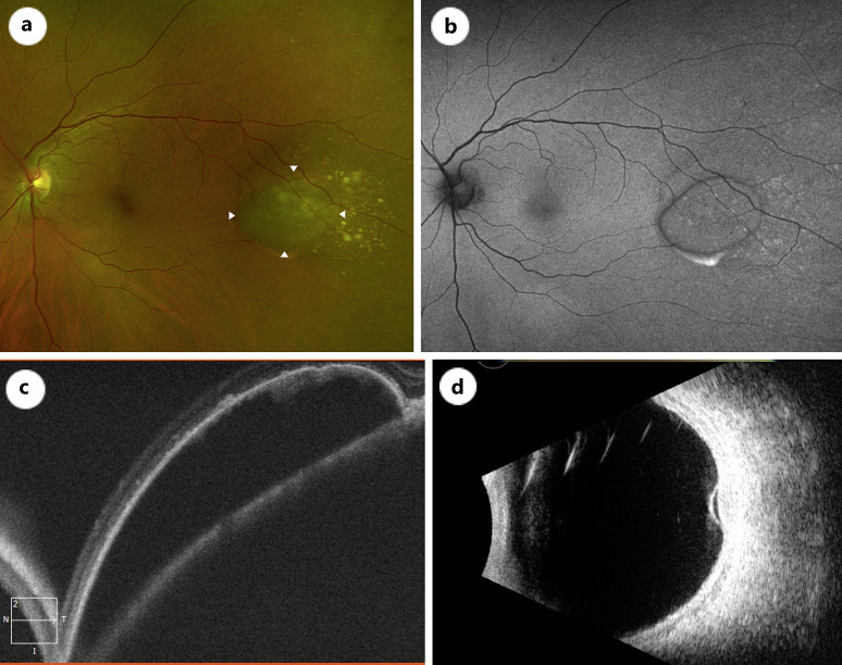 Case Series: Retinal Pigment Epithelial Detachments Over Choroidal Nevi - What Is the Clinical Significance?